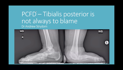PCFD - Tibialis Posterior Is N...